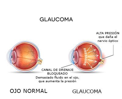 Glaucoma.jpg