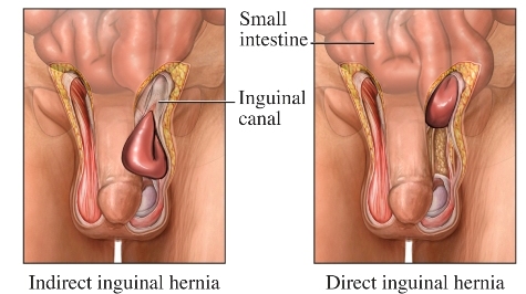 Hernia inguinal 